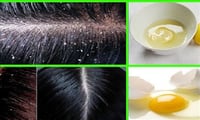 How to get rid of Dandruff naturally? 